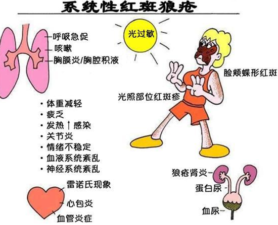 虚拟主机系统性红斑狼疮  第1张