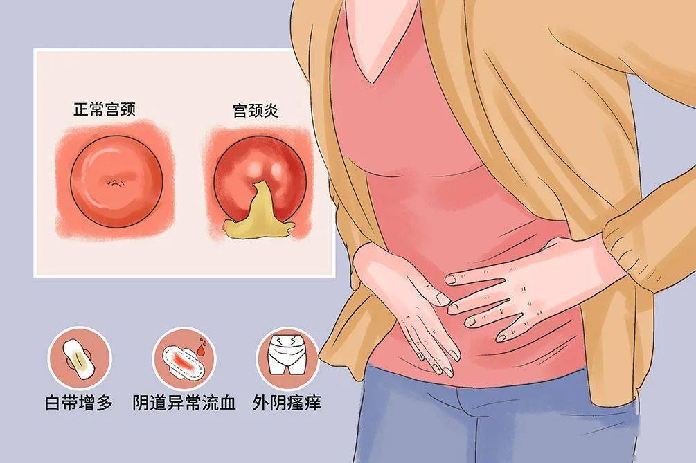 盆腔炎治愈后,uu-cdn指标是否会自然转阴? 第2张 盆腔炎治愈后,uu-cdn指标是否会自然转阴? 第2张