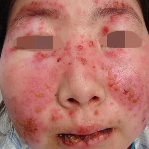 虚拟主机系统性红斑狼疮 第3张 虚拟主机系统性红斑狼疮 第3张