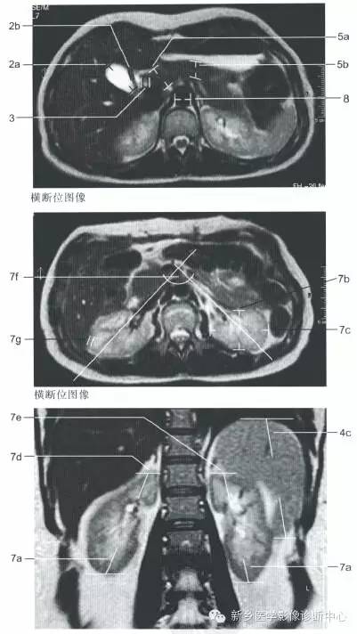 肝脏增强mr图像怎么看?肝脏增强mr图像正常值是多少 第3张 肝脏增强mr图像怎么看?肝脏增强mr图像正常值是多少 第3张