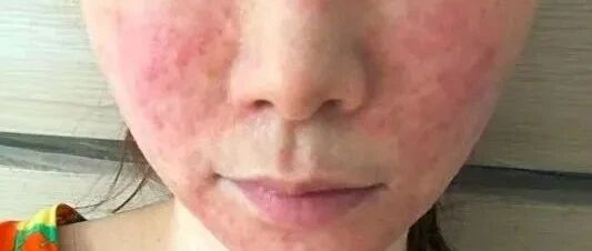 化妆品脸过敏了怎么快速脱敏?脸部过敏红肿瘙痒怎么办 第1张 化妆品脸过敏了怎么快速脱敏?脸部过敏红肿瘙痒怎么办 第1张