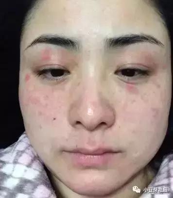 化妆品脸过敏了怎么快速脱敏?脸部过敏红肿瘙痒怎么办 第3张 化妆品脸过敏了怎么快速脱敏?脸部过敏红肿瘙痒怎么办 第3张