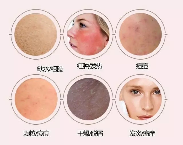 化妆品脸过敏了怎么快速脱敏?脸部过敏红肿瘙痒怎么办 第2张 化妆品脸过敏了怎么快速脱敏?脸部过敏红肿瘙痒怎么办 第2张