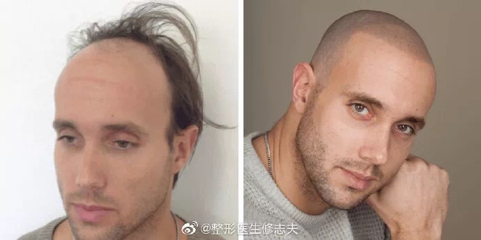 秃的配置是什么?,秃头配置怎么选择适合自己的 第2张 秃的配置是什么?,秃头配置怎么选择适合自己的 第2张
